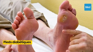 Prendre soin de ses pieds quand on est diabétique : Une étape cruciale pour une vie saine