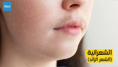 فهم الشعرانية (الشعر الزائد)