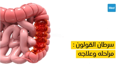 سرطان القولون : مراحله وعلاجه