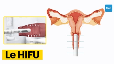 HIFU gynécologique : une nouvelle technique prometteuse