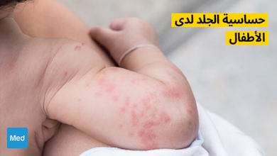 حساسية الجلد لدى الأطفال