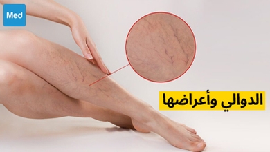 الدوالي وأعراضها