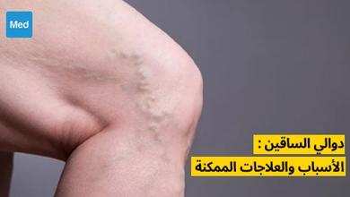 دوالي الساقين : الأسباب والعلاجات الممكنة