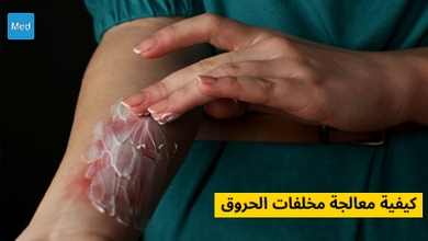 كيفية معالجة مخلفات الحروق 