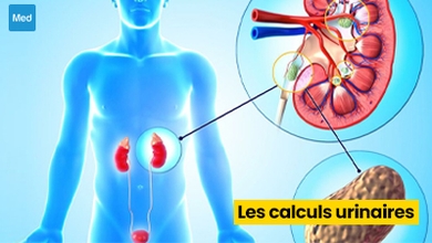 Les calculs urinaires : causes, symptômes et traitements