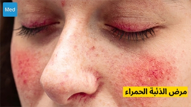 الذئبة الحمراء : فهم هذا المرض المناعي الذاتي