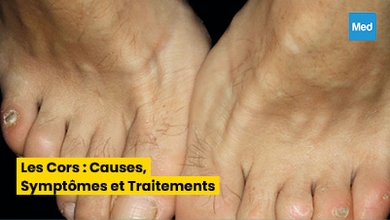 Les Cors : Causes, Symptômes et Traitements