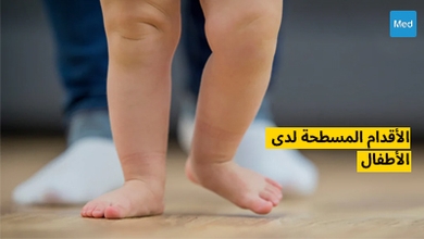 الأقدام المسطحة لدى الأطفال