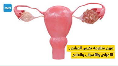 فهم متلازمة تكيس المبايض: الأعراض والأسباب والعلاج