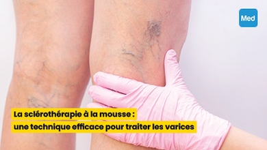 La sclérothérapie à la mousse : une technique efficace pour traiter les varices