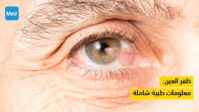 ظفر العين: معلومات طبية شاملة