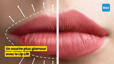Un sourire plus glamour avec le Lip Lift