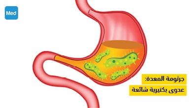 جرثومة المعدة: عدوى بكتيرية شائعة