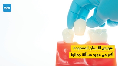 تعويض الأسنان المفقودة : أكثر من مجرد مسألة جمالية
