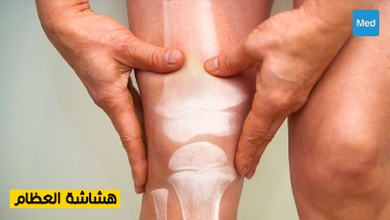 هشاشة العظام