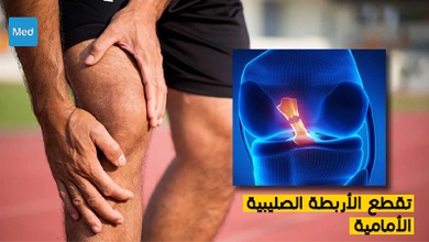 تقطع الأربطة الصليبية الأمامية