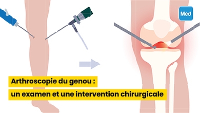 Arthroscopie du genou : un examen et une intervention chirurgicale