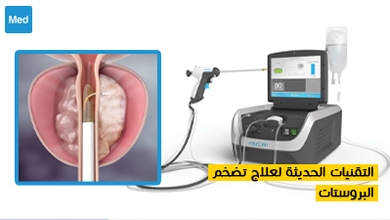 التقنيات الحديثة لعلاج تضخم البروستات