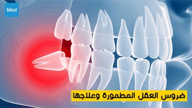 ضروس العقل المطمورة وعلاجها