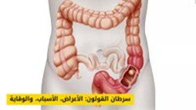 سرطان القولون: الأعراض، الأسباب، وكيفية الوقاية والتشخيص المبكر