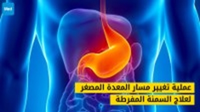 عملية تغيير مسار المعدة المصغر لعلاج السمنة المفرطة