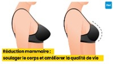 Réduction mammaire : soulager le corps et améliorer la qualité de vie
