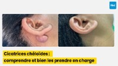 Cicatrices chéloïdes : comprendre et bien les prendre en charge