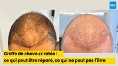Greffe de cheveux ratée : ce qui peut être réparé, ce qui ne peut pas l
