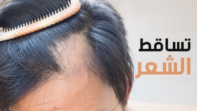 تساقط الشعر 