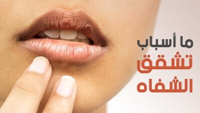 ما أسباب تشقق الشفاه