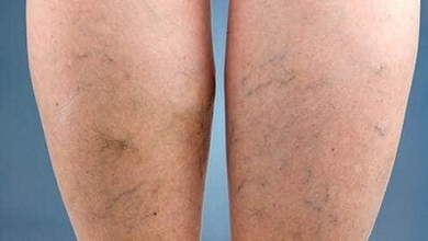 دوالي الساقين مشكلة ولها حلول .. تعرفوا عليها 