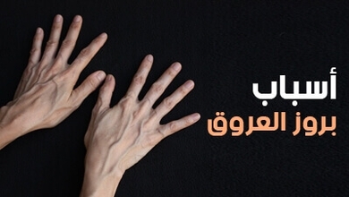 أسباب بروز العروق