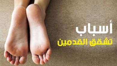 أسباب تشقق القدمين
