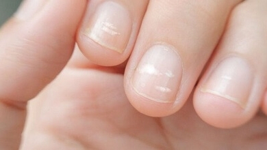البقع البيضاء على الاظافر .. على ماذا تدل ؟؟ 