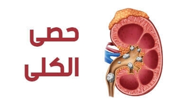حصى الكلى 