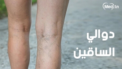 دوالي الساقين