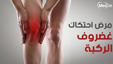 مرض احتكاك غضروف الركبة