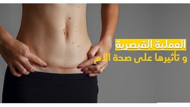 العملية القيصرية و تأثيرها على صحة الأم