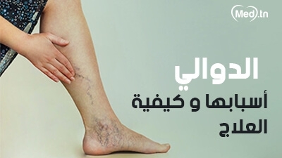 الدوالي أسبابها و كيفية العلاج