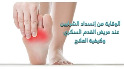 الوقاية من إنسداد الشّرايين عند مريض القدم السّكّري وكيفيّة العلاج