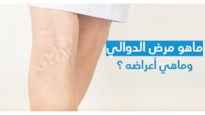 ماهو مرض الدّوالي وماهي أعراضه ؟