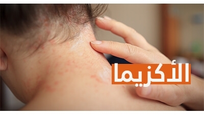 الأكزيما