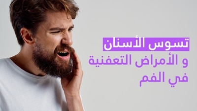 تسوّس الأسنان و الأمراض التّعفنية في الفم