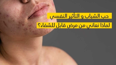  حب الشّباب والأذى النّفسي لماذا نعاني من مرض قابل للشّفاء؟