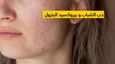 حب الشباب و بيروكسيد البنزول