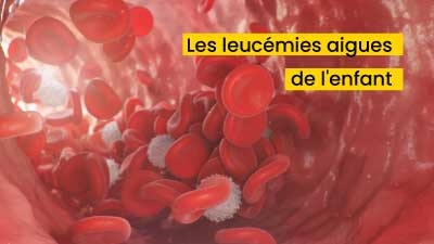Les leucémies aigues de l'enfant
