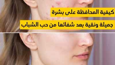 كيفية المحافظة على بشرة جميلة ونقية بعد شفائها من حب الشباب