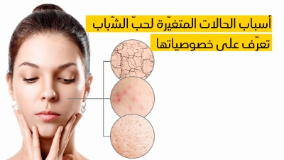 أسباب الحالات المتغيّرة لحبّ الشّباب وكيفيّة علاجها