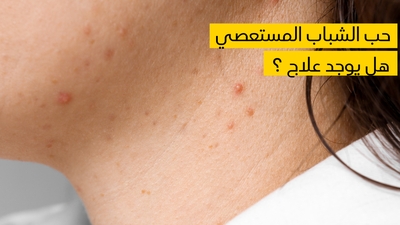 حب الشباب المستعصي هل يوجد علاج ؟