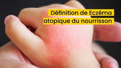 Définition de Eczéma atopique du nourrisson